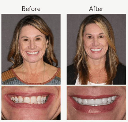 We used our specialized bite computer to find her ideal bite and rebuild all of her teeth to this new bite.