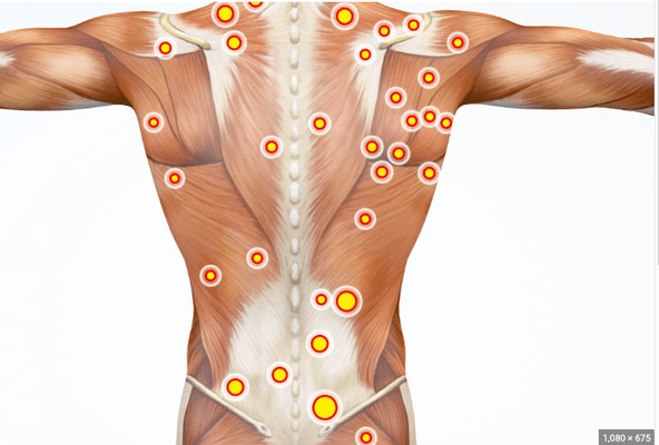 Trigger point massage