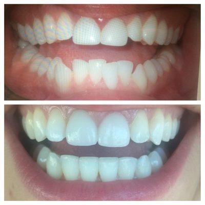 Before and after Invisalign!!! So happy!!