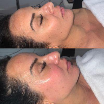 *Hydro Facial GLOW * Before and After