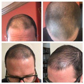 Scalp Micropigmentation is tiny dots applied to the scalp to create the allusion of hair follicles.