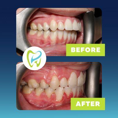 Take a look at this amazing bite correction using braces. Call us today to schedule an appointment!