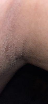 Hair left on left underarm