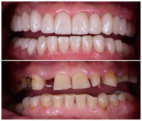 Full mouth reconstruction with crowns.