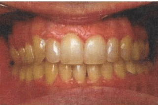 End of an orthodontic treatment.