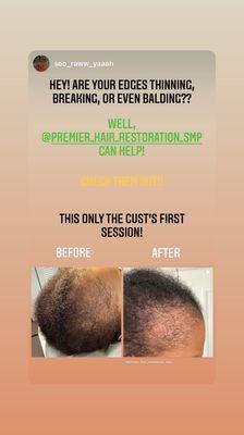 Premier Hair Restoration Smp