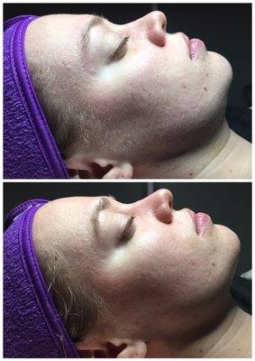 Dermaplane + Facial