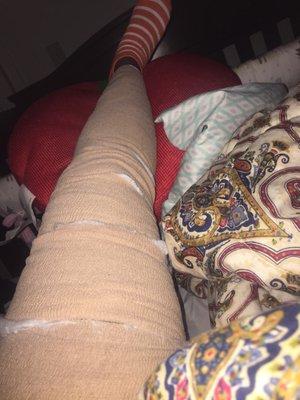 My leg wrapped the first night