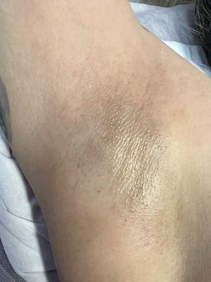 Underarm sugaring results