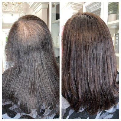 Non Surgical Hair Replacement