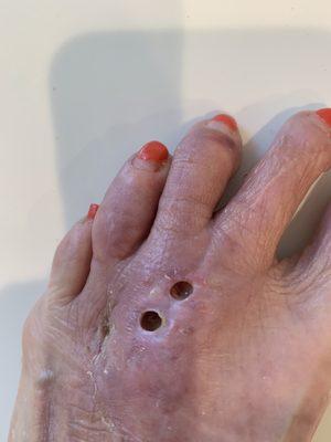 Would you like your foot to look like this in mid July after a common foot surgery performed on May 3?