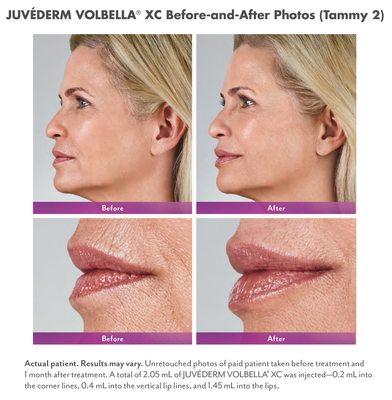 Orlando Juvederm Injections $100 off + Complimentary Consultation