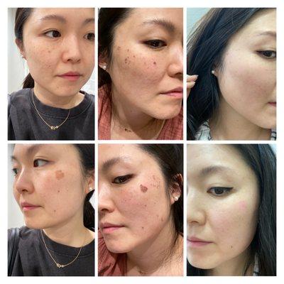 Picosure Laser- First treatment. here is a photo of my progress on day 1, day 3, and day 5.