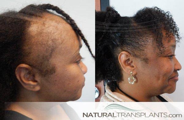 Natural Transplants, Hair Restoration Clinic