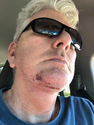 This is my chin 6 days after the surgery. The bruising went away pretty quickly. The scar is still healing and will take a while, I'm sure.