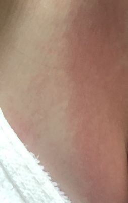 This is the red blisters on my daughters back from the chlorine burn about 30 minutes after the pool after a 10 minute rinse.