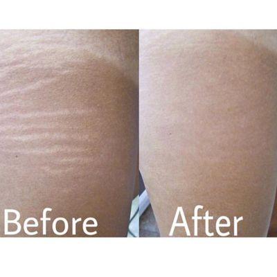 Stretch mark, vitiligo and scar camouflage