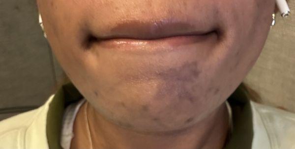 After my skin finished peeling, now I have a new patch of hyperpigmentation to treat.