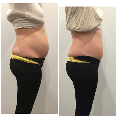 Waist reduction after just 1 treatment - Laser Lipo Open House