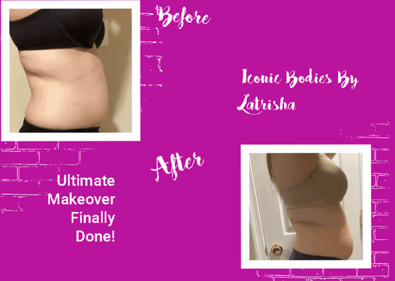 Results After 2 Sessions of Lipo Cavitation.