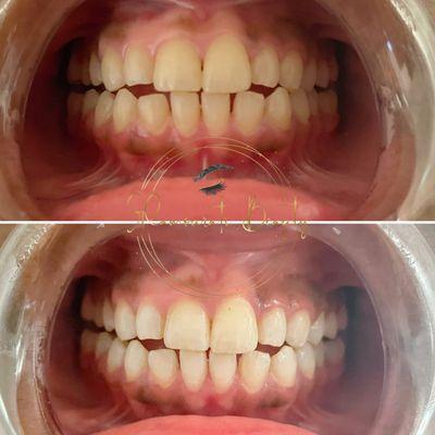 Cosmetic teeth whitening- results after 20 minutes