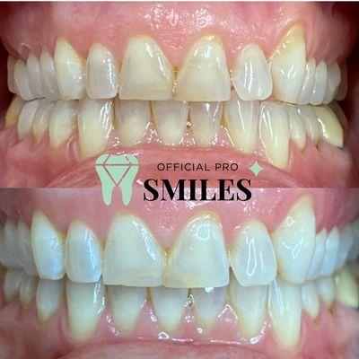 Teeth Whitening Services at official pro smiles chandler az