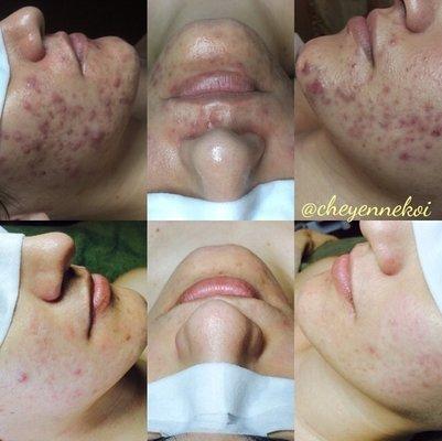 Before & After Acne treatment