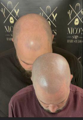 A before, and after photo of a scalp micro pigmentation
For more information check out our website  nicosmpandhair.com