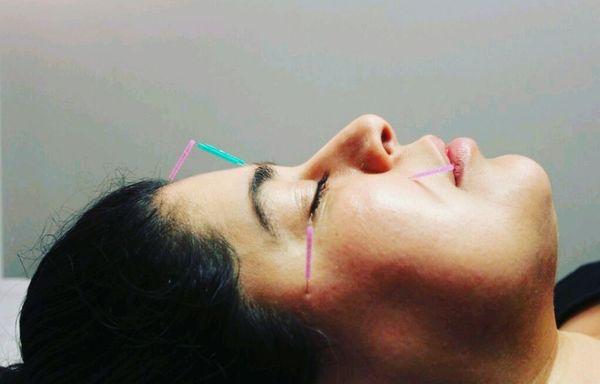 Facial cosmetic acupuncture