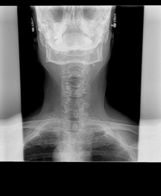 patient with subluxations in there neck.