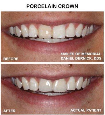 Big difference with just two porcelain crowns!