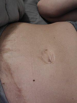 My belly button and you can see how high my incision was for the tuck . Goes way above the bikini line