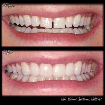 Porcelain Veneers Creating Beautiful Smile; Dentist in Montebello