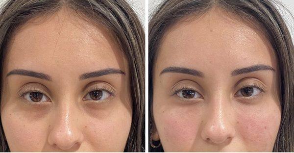 Undereye Filler