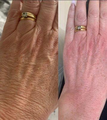 As women our hands are the first thing that shows our age. This is easily corrected by Fibroblasting the damaged area.