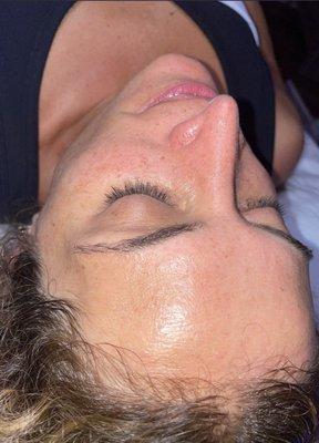 After hydrafacial glow