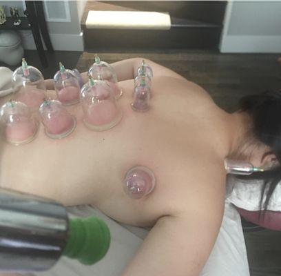 cupping therapy, amazing stress relief & circulation, loosen tight muscles