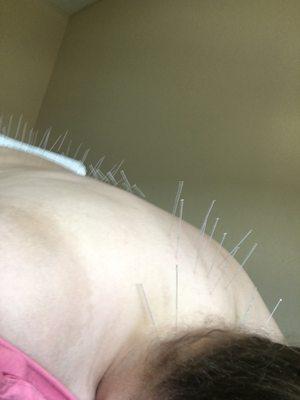 Dry needling by Dr Fishkin, 2018.