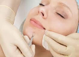 Blackheads extractions