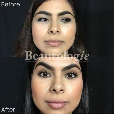 Lip Fillers 1cc Restylane Lyft Before and After by Dr. Milan Shah