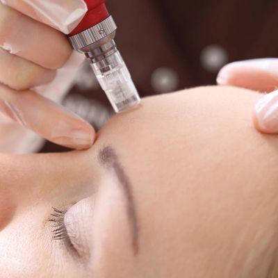 Micro needling