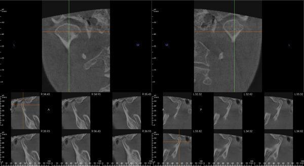 Cone beam CT TMJ imaging