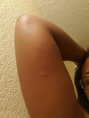 This is what I woke up too, after their so called bug spray..bedbug bite