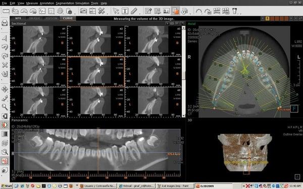 Ofreciendo Lo mas nuevo en technologia dental. Tomografia Computarizada para todos nuestros pacientes de Implantes dentales. Gratis!!