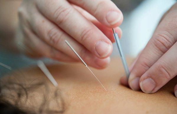 Life Long Acupuncture