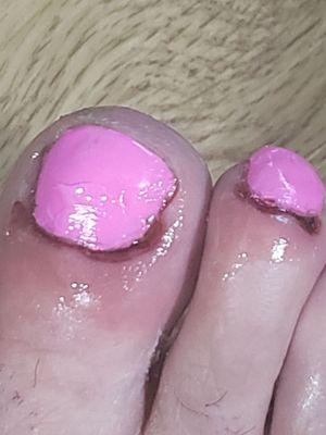 A botched pedicure!