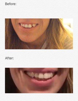 Before and after teeth bonding (AKA "magic") in one visit! Dr. Jafari rocks!