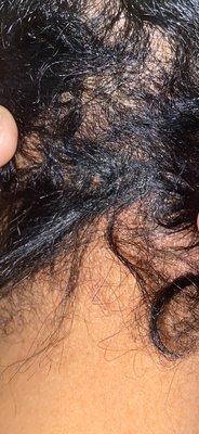 Chemical burn from relaxer back of scalp on left side