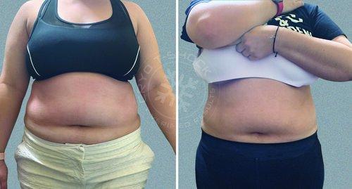 T-Shock Cryo - Fat reduction - treatment every 15 days