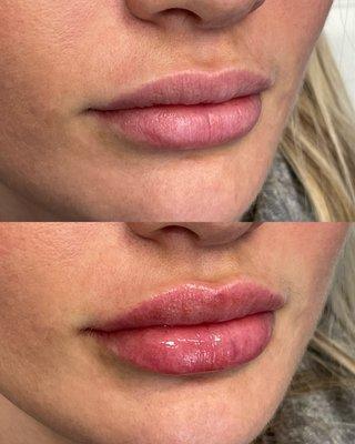 Lip filler before and after